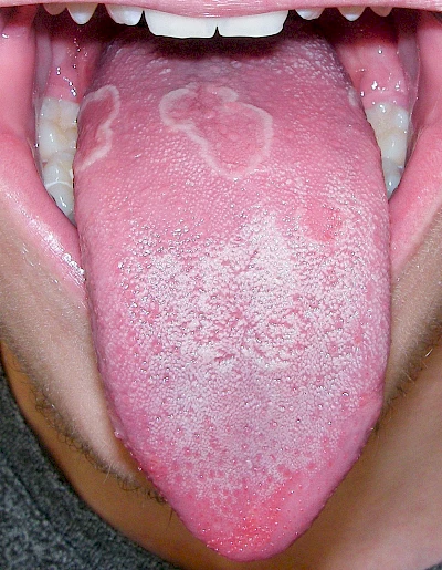 Beispiele: Landkartenzunge