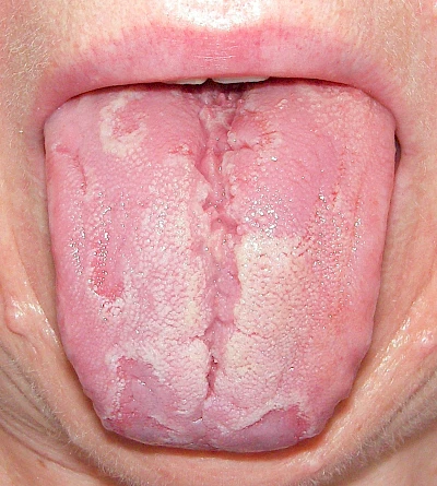 Beispiele: Landkartenzunge