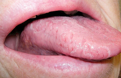 Beispiele: Landkartenzunge