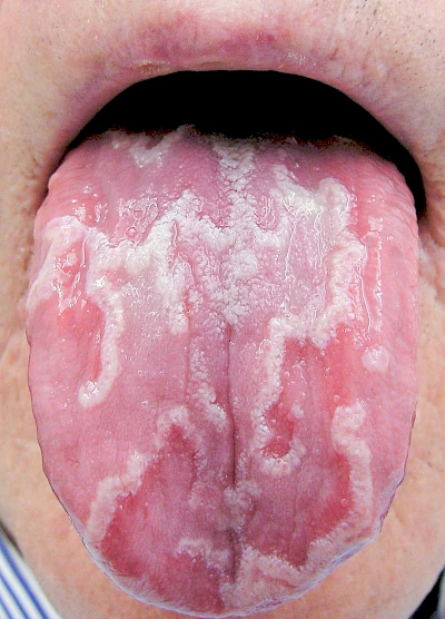 Beispiele: Landkartenzunge