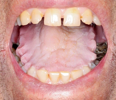 Beispiele: Grilanden & Zahnimpressionen