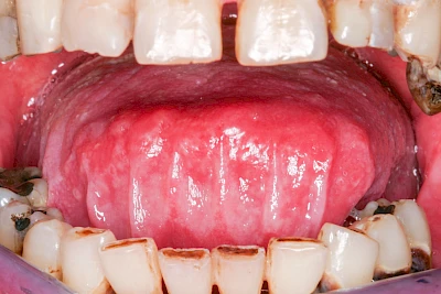 Beispiele: Grilanden & Zahnimpressionen