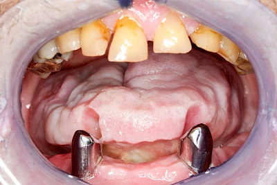 Beispiele: Grilanden & Zahnimpressionen