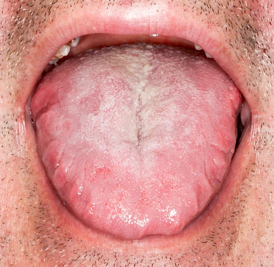 Beispiele: Grilanden & Zahnimpressionen