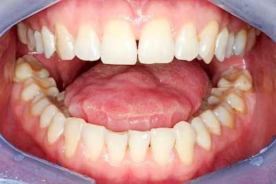 Beispiele: Grilanden & Zahnimpressionen