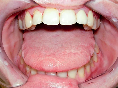 Beispiele: Grilanden & Zahnimpressionen