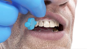 Interdentalbürste