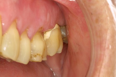 Beispiele: Plaque (Biofilm), Zahnstein & Konkrement