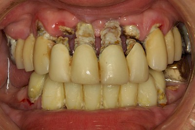 Beispiele: Plaque (Biofilm), Zahnstein & Konkrement