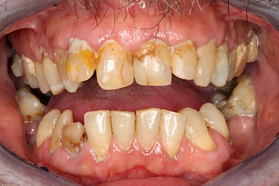 Beispiele: Plaque (Biofilm), Zahnstein & Konkrement