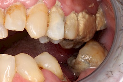 Beispiele: Plaque (Biofilm), Zahnstein & Konkrement