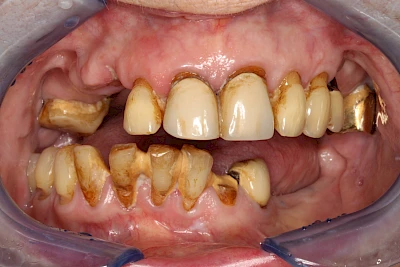 Beispiele: Plaque (Biofilm), Zahnstein & Konkrement