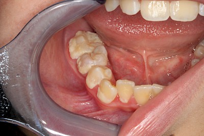 Beispiele: Plaque (Biofilm), Zahnstein & Konkrement