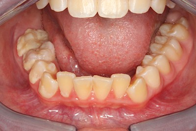 Beispiele: Plaque (Biofilm), Zahnstein & Konkrement