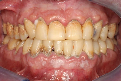 Beispiele: Plaque (Biofilm), Zahnstein & Konkrement