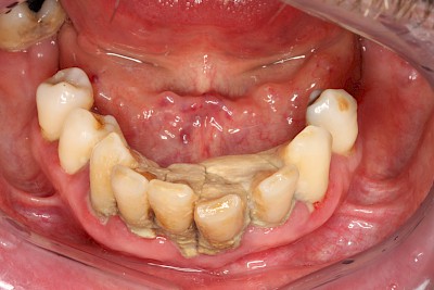 Beispiele: Plaque (Biofilm), Zahnstein & Konkrement