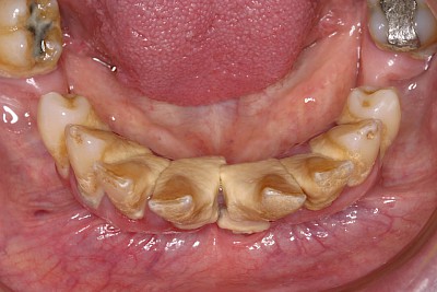 Beispiele: Plaque (Biofilm), Zahnstein & Konkrement