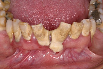 Beispiele: Plaque (Biofilm), Zahnstein & Konkrement