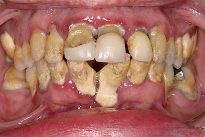 Beispiele: Plaque (Biofilm), Zahnstein & Konkrement