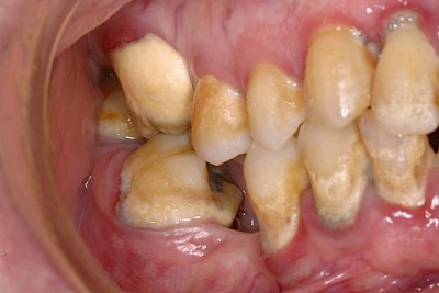 Beispiele: Plaque (Biofilm), Zahnstein & Konkrement