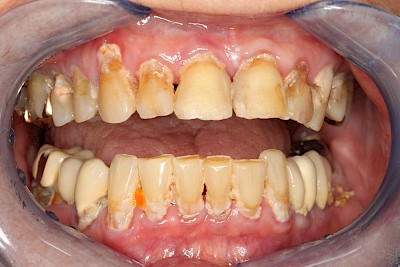 Beispiele: Plaque (Biofilm), Zahnstein & Konkrement