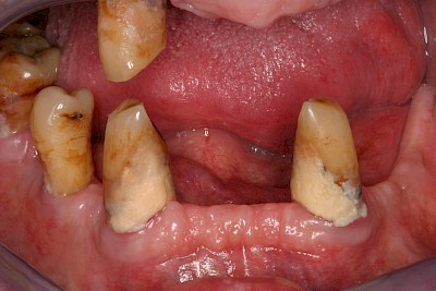 Beispiele: Plaque (Biofilm), Zahnstein & Konkrement