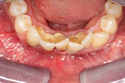 Beispiele: Plaque (Biofilm), Zahnstein & Konkrement