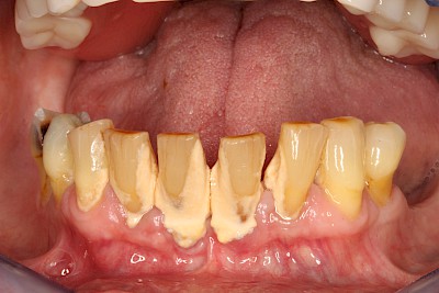 Beispiele: Plaque (Biofilm), Zahnstein & Konkrement