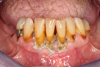 Beispiele: Plaque (Biofilm), Zahnstein & Konkrement