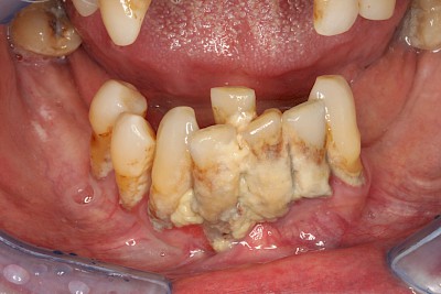 Beispiele: Plaque (Biofilm), Zahnstein & Konkrement