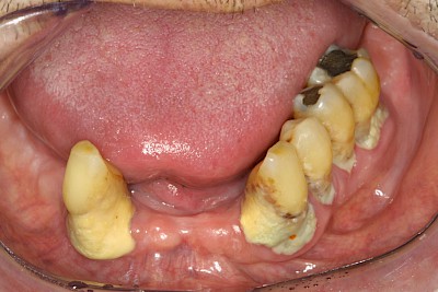 Beispiele: Plaque (Biofilm), Zahnstein & Konkrement