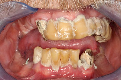 Beispiele: Plaque (Biofilm), Zahnstein & Konkrement