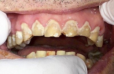 Beispiele: Plaque (Biofilm), Zahnstein & Konkrement