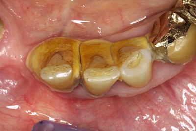 Beispiele: Plaque (Biofilm), Zahnstein & Konkrement