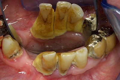 Beispiele: Plaque (Biofilm), Zahnstein & Konkrement