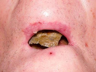 Beispiele: Borken