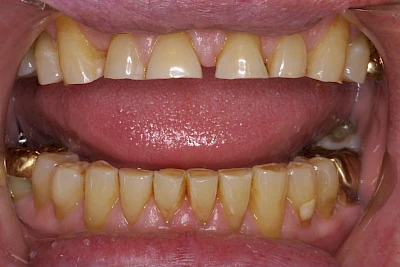 Beispiele: Abnutzung