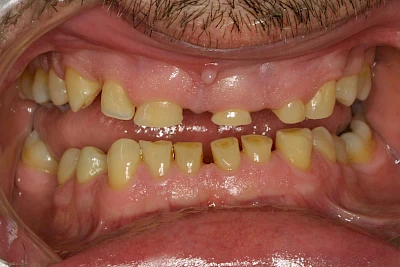 Beispiele: Abnutzung