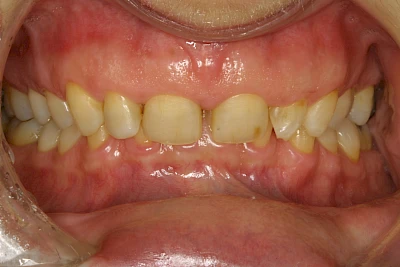 Beispiele: Abnutzung