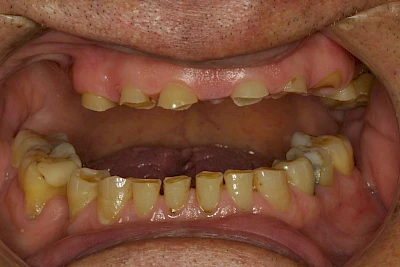 Beispiele: Abnutzung