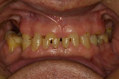 Beispiele: Abnutzung