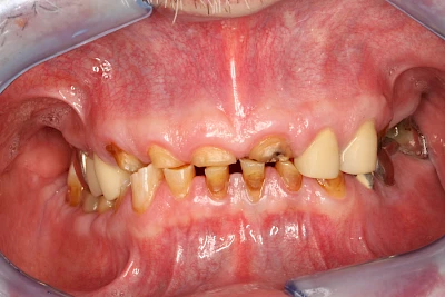 Beispiele: Abnutzung