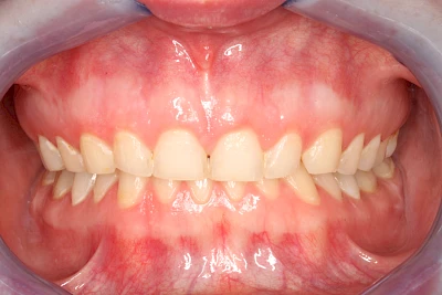 Beispiele: Abnutzung