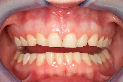 Beispiele: Abnutzung