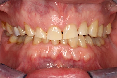 Beispiele: Abnutzung