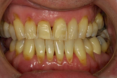 Beispiele: Keilförmiger Defekt