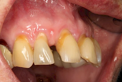 Beispiele: Keilförmiger Defekt