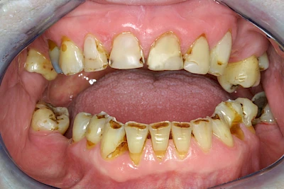 Beispiele: Keilförmiger Defekt