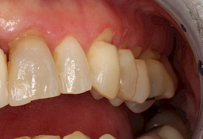 Beispiele: Keilförmiger Defekt