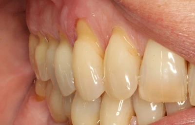 Beispiele: Keilförmiger Defekt